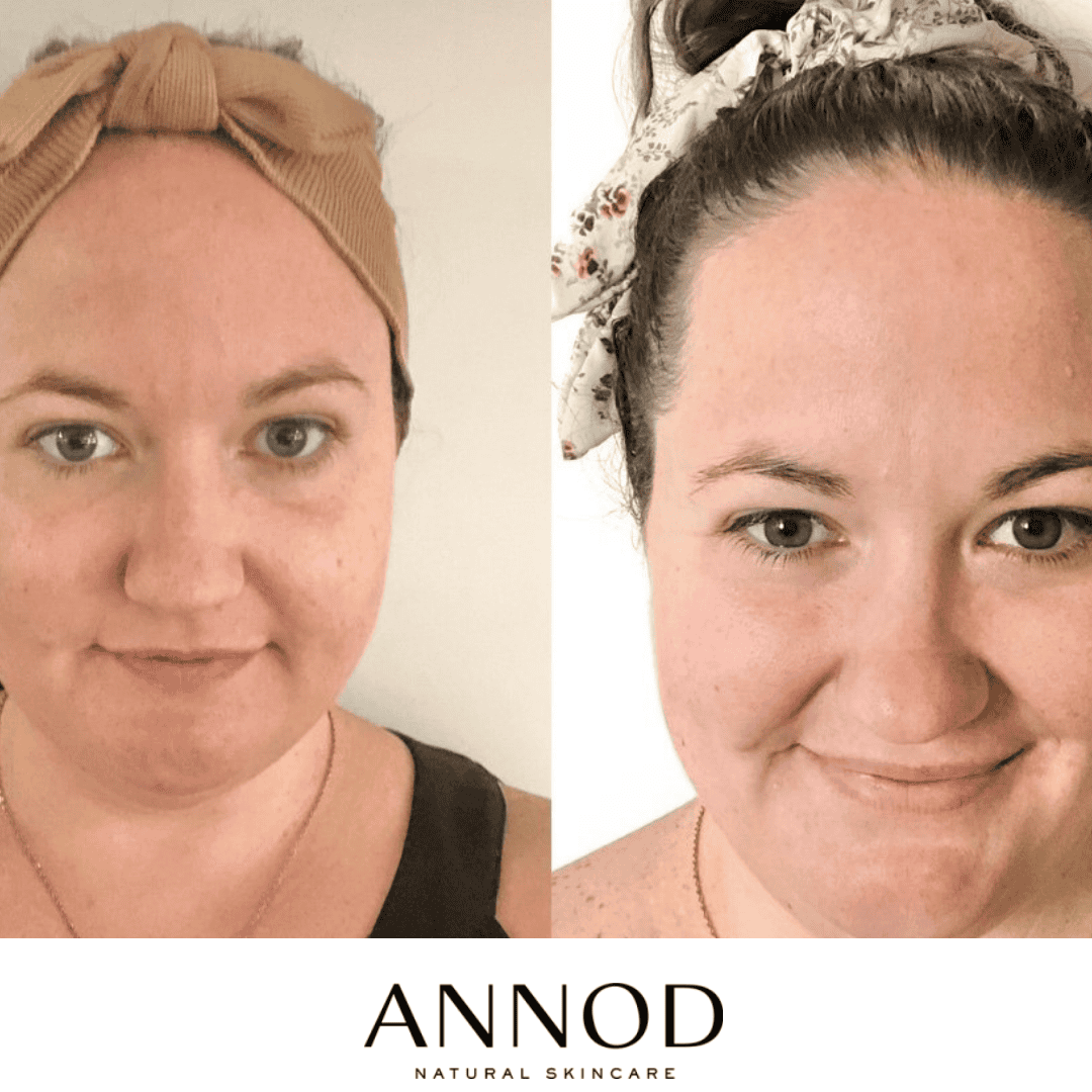 Dull uneven skin Before and healthy bright skin After after using Moisturising Rose Face Oil